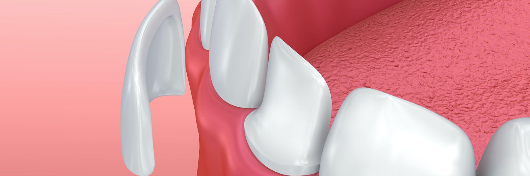 illustration of dental veneers